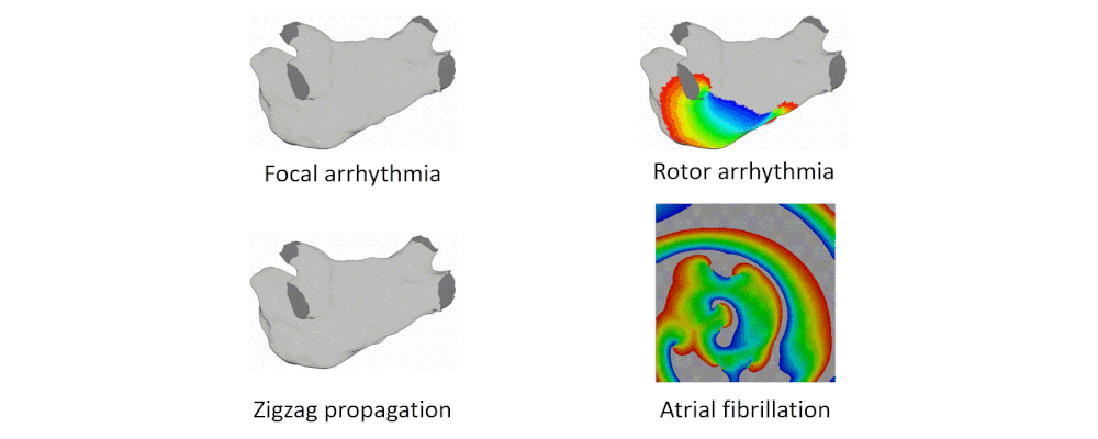 Patient-specific Heart Modeling for Arrhythmia Ablation